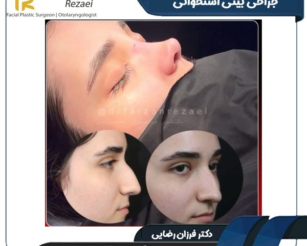 جراحی بینی استخوانی