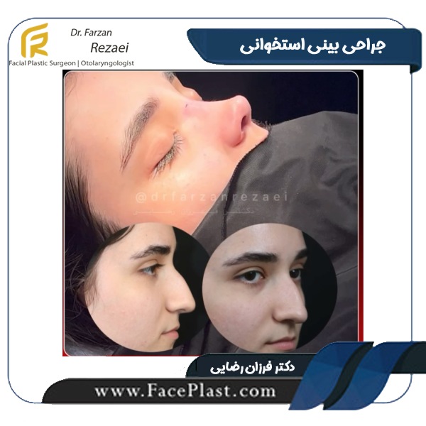 جراحی بینی استخوانی